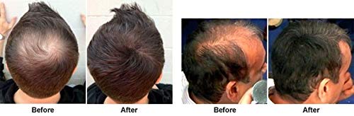 ПРОПИДЕКС-Премиум Третмани За Повторно Растење На Косата со Биотин &засилувач; Видов Палмето За Стимулирање На Фоликулите на