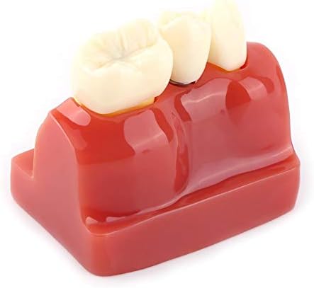 Fafeicy Dental Model, Educational Dental Resin Educational Somentation Model Analysy Implant Analysis Crown Bridge за стоматолошко