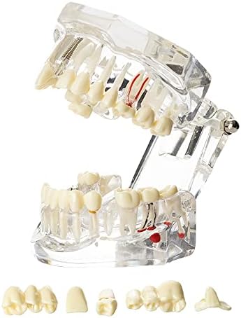 Dentalmall Dental Oral Typodont Model Implant Patholog, отстранлив Научи демо -видлива анатомија демонстрација на настава стандардна