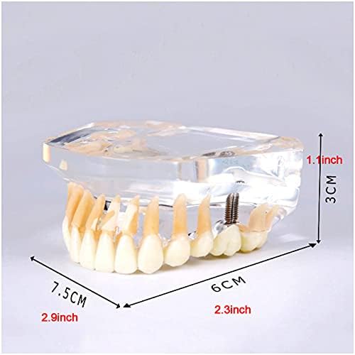 Kh66zky преголем дел од мандибуларните заби модел Инфериорни прецизни импланти Демо Стандарден стоматолошки заби модел за училишно образование