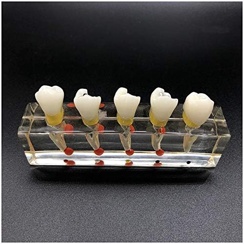 KH66ZKY Дентолошки 5-фаза Ендодонтски третман модел Кариес на моделот на модели на ендодонтски реставрација на заби за студии